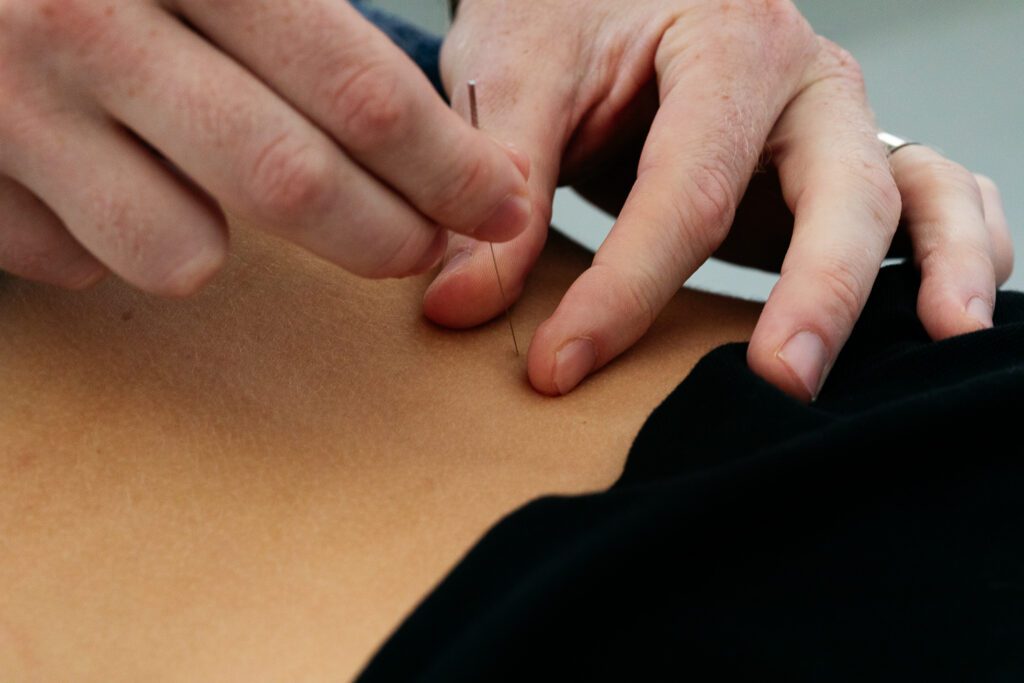 Chiropractor inserting a needle into a trigger point on patient's lower back.